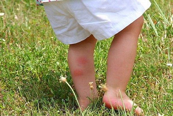 Natura periculoasă: cum acordăm copilului primul ajutor în caz de înţepături de insecte