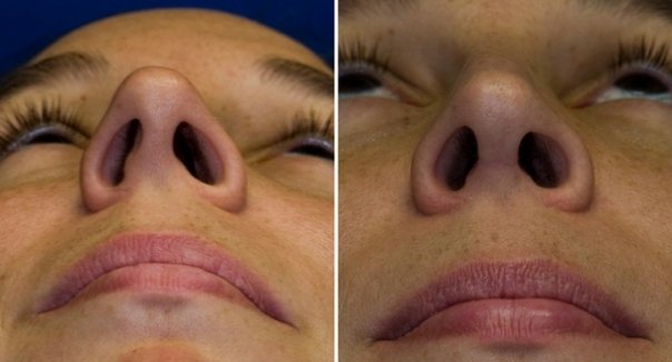 Искривление перегородки носа – последствия и лечение