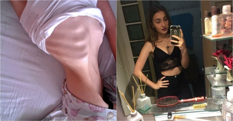 Povestea unei anorexice a devenit virală
