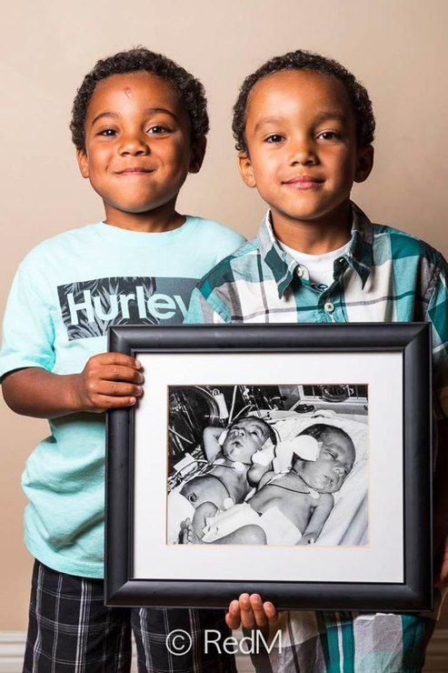 Выросшие дети, которые родились раньше срока, показали свои первые фото