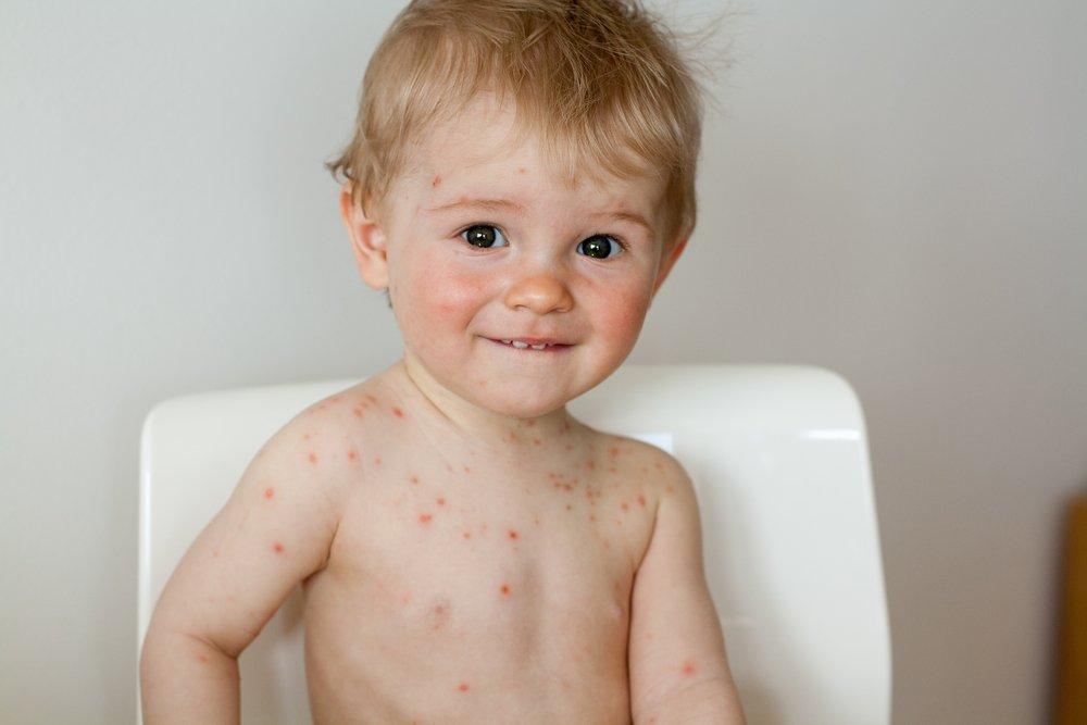 Cu ce tratăm varicela la copii pe lângă verdele de briliant: metode moderne și eficiente