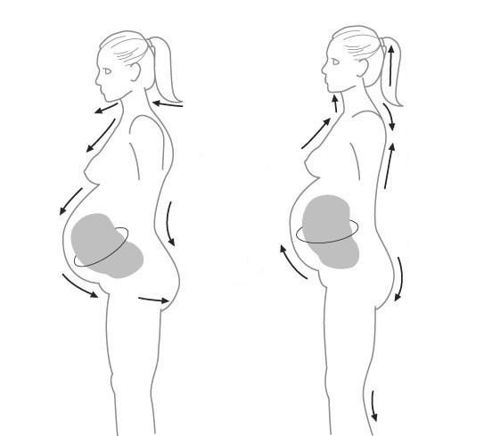 Hernia de disc în sarcină, problema pe care poți să o previi