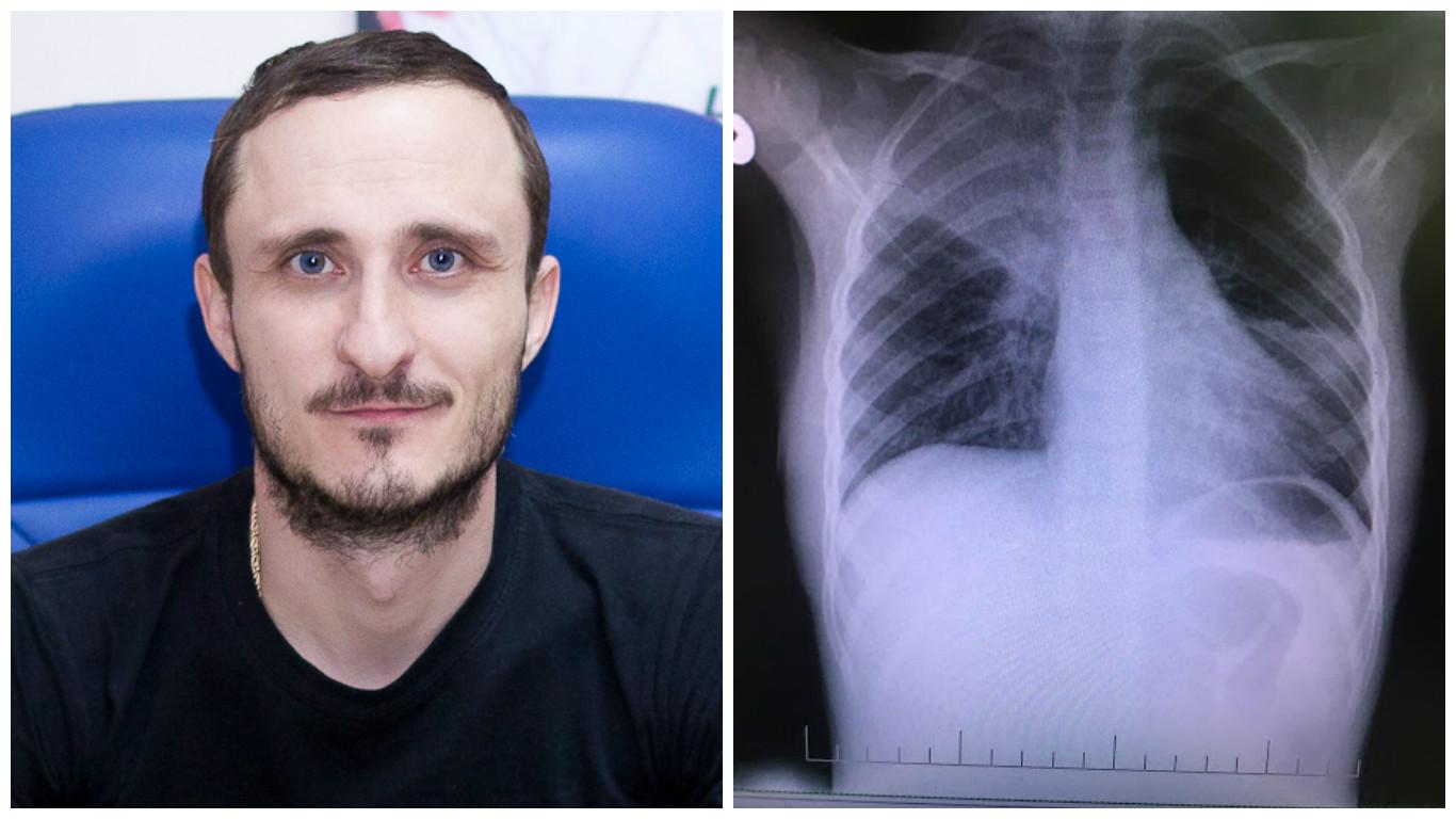 Mihai Stratulat: „Pneumonie vs Bronșită obstructivă...”