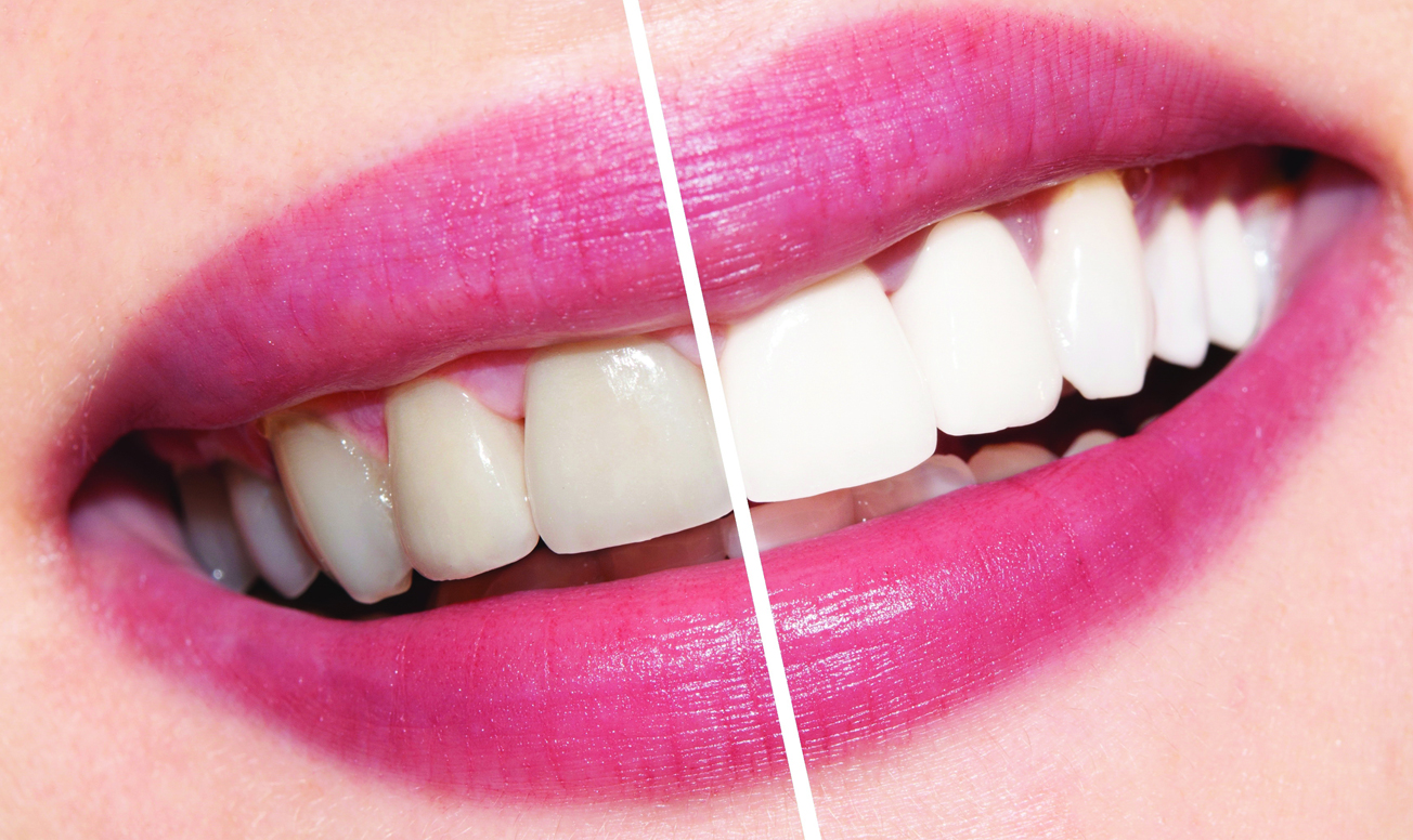 4 эффективных способа отбелить зубы в домашних условиях при помощи натуральных средств