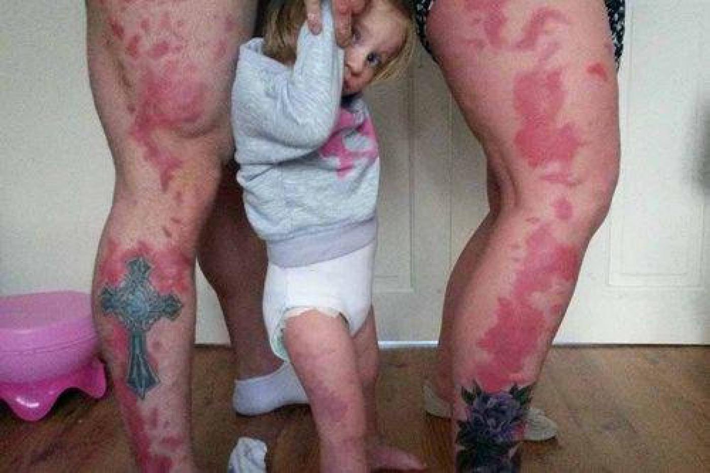 Родители сделали «татуировки-шрамы», чтобы поддержать маленькую дочь